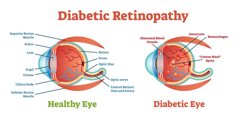 diabetic retinopathy | Jacksonville FL diabetic retinopathy | Jacksonville FL